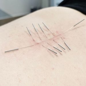 akupunktura aleksandra orlowska gryfino