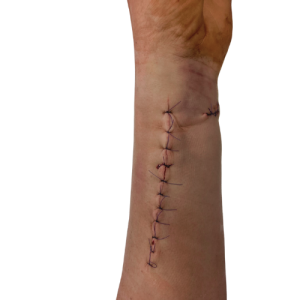 leczenie blizn gryfino aleksandra orlowska