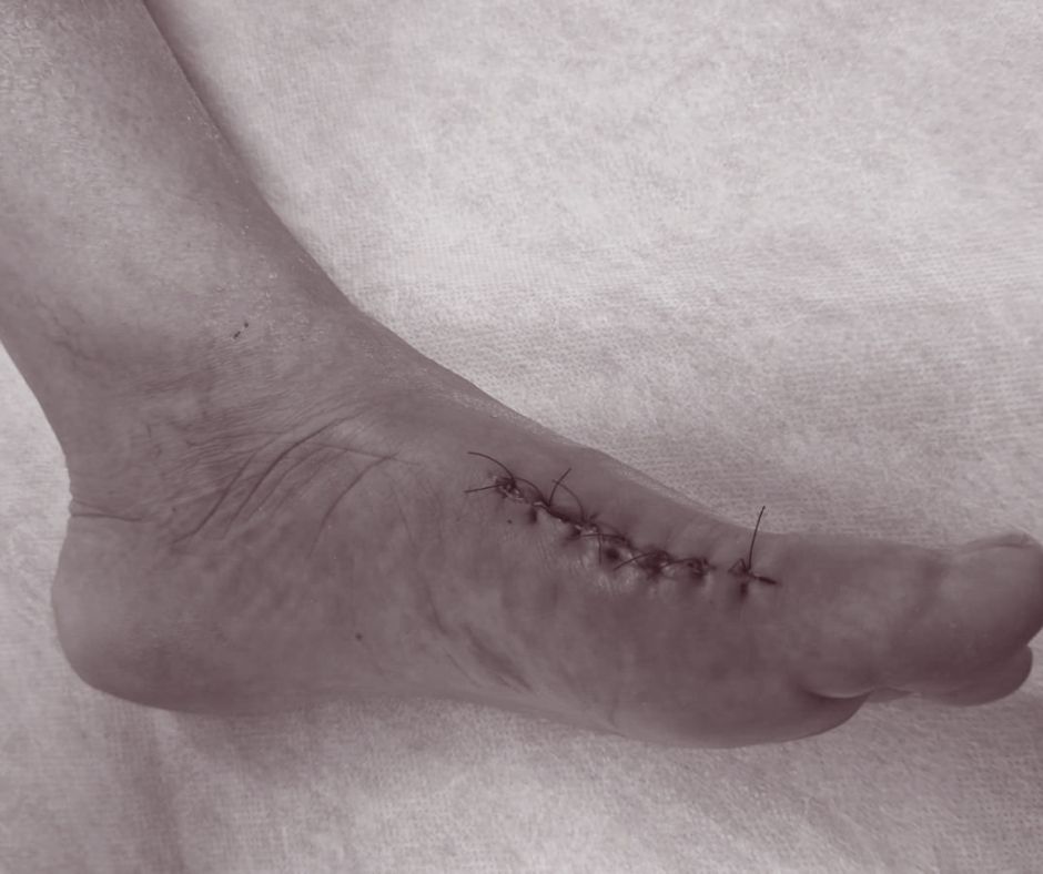 Sztywny paluch (hallux rigidus) po operacji – wczesny okres pooperacyjny